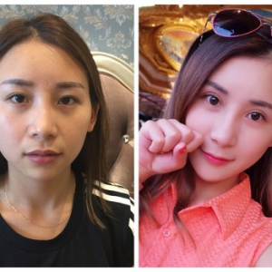 国内整形专家：99%的人都不知道的关于整容下颌的真相