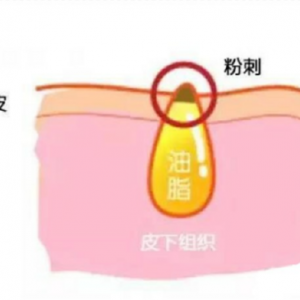 事实胜于雄辩：甲硝锉凝胶去黑头杠杠的