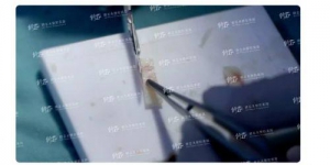 修志夫鼻综合:为什么都选择用肋软骨来做鼻综合?