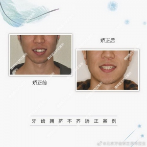 2年多的日夜等待终让拥挤牙齿排齐，小伙儿如愿获得自信笑容