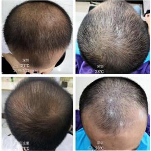 低成本小投资的创业典范，艾可迅头皮微生态健康养生